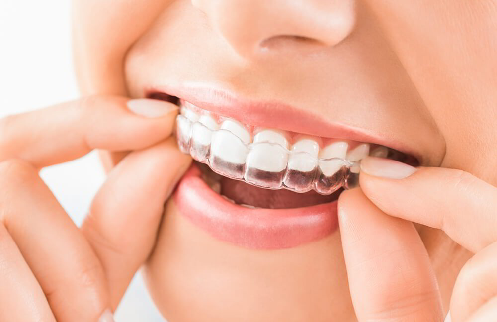 Niềng răng trong suốt Invisalign