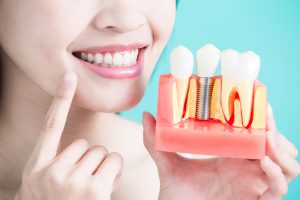 Dental Implants Carmel Mountain Ranch San Diego