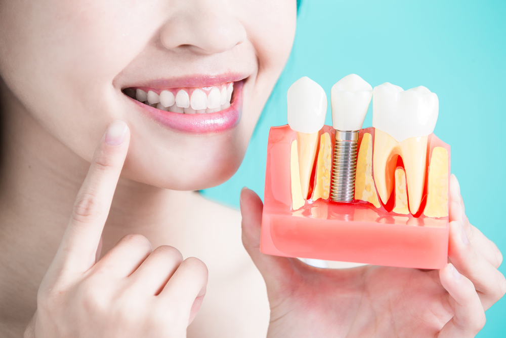 6 ĐIỀU CẦN TRÁNH SAU KHI CẤY RĂNG IMPLANT THÀNH CÔNG 1 Dental Implants Carmel Mountain Ranch San Diego