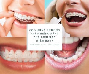 Có những phương pháp niềng răng phổ biến nào hiện nay?