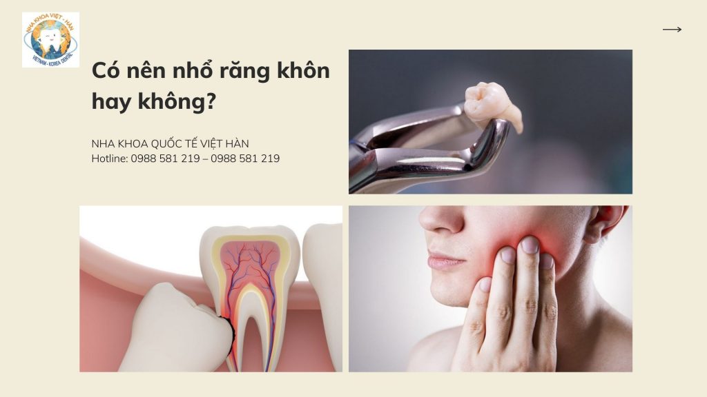 Có nên nhổ răng khôn hay không?