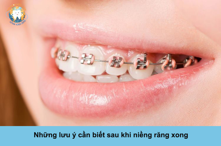 Những lưu ý cần biết sau khi niềng răng xong