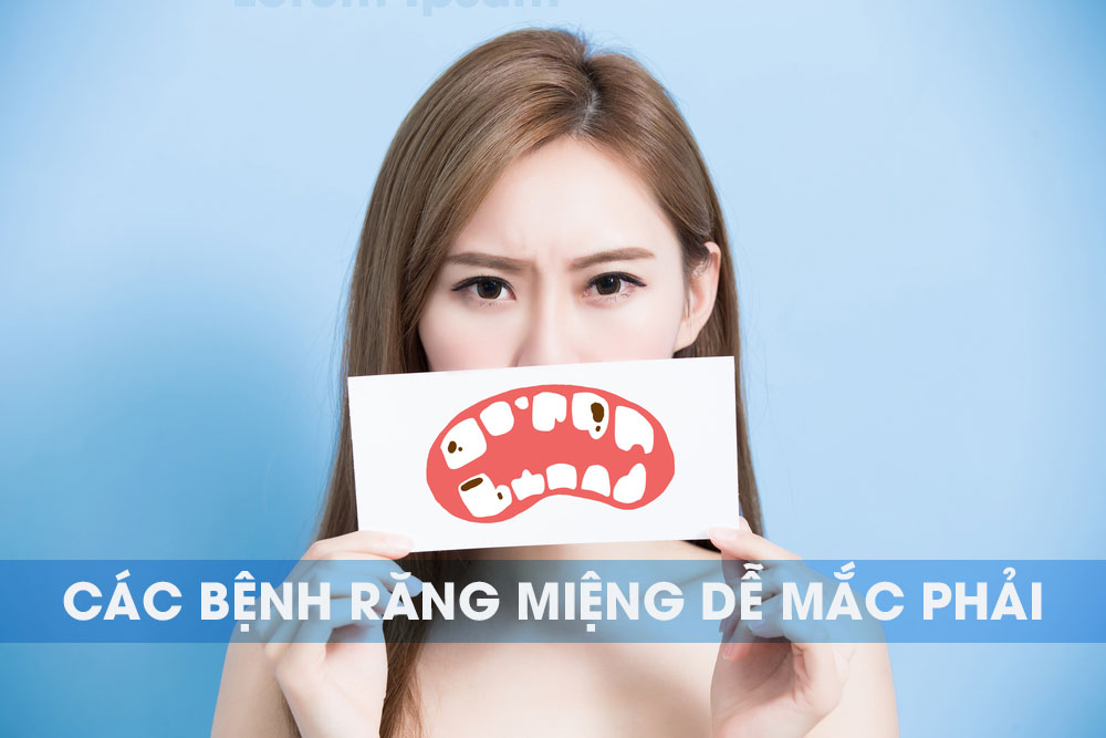 benh ve rang mieng AB