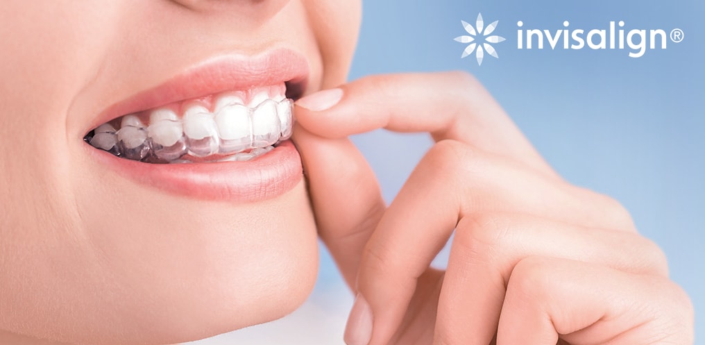 Niềng răng Invisalign đi ngần ngại chi? 1 nieng rang Invisalign 1
